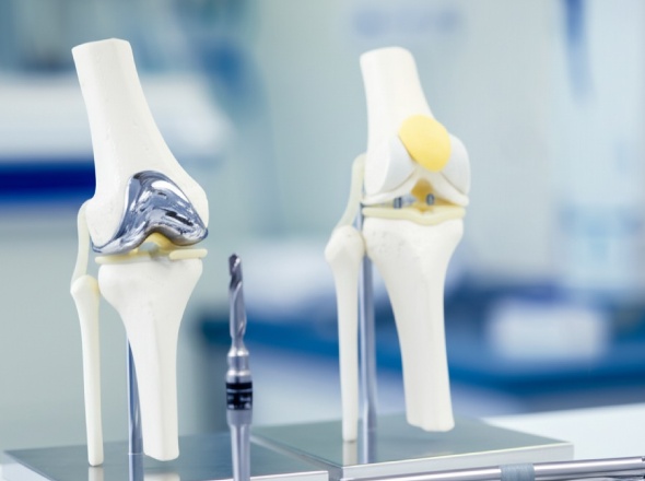 Orthopedic implant models with precision-threaded components